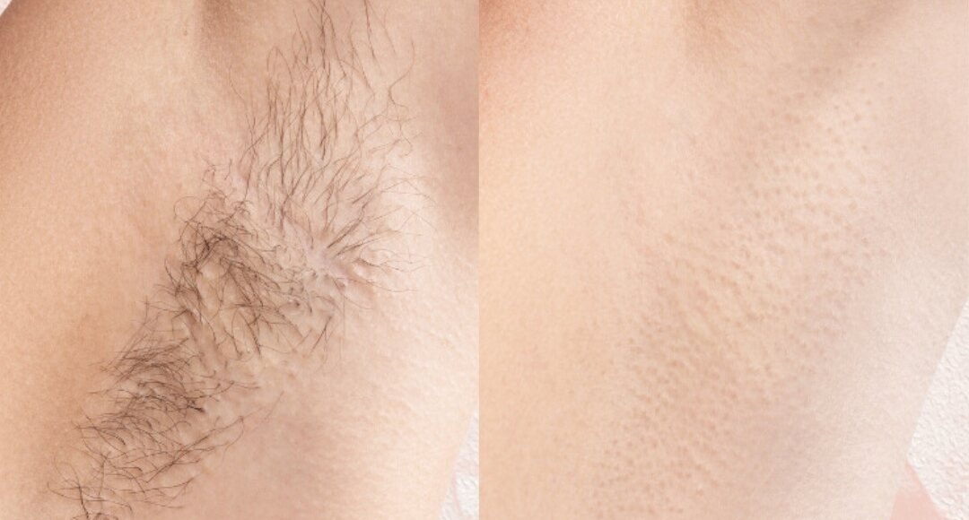Vóór en na een laserkuur bij Elite Laser Clinic: oksel met haargroei en dezelfde oksel zijdezacht