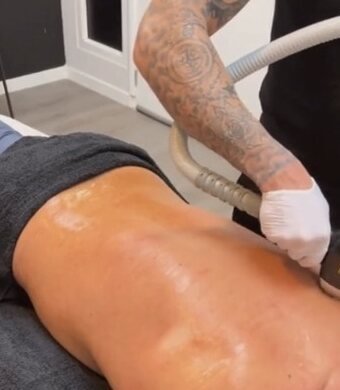 Rugbehandeling met de Diode Ice Laser bij Elite Laser Clinic Rijen, uitgevoerd door de mannelijke specialist